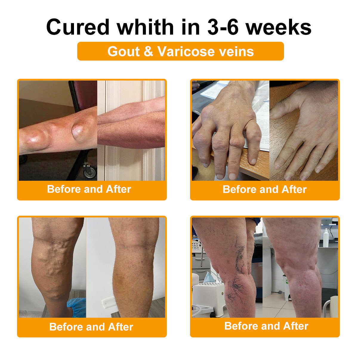 🎁Flash Sale - ODALIT™ Botulinum Toxin & Bee Venom Pain-Relief Bone Healing Cream🐝💎